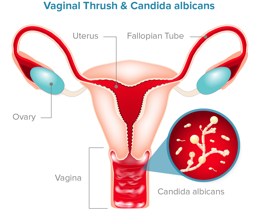 Vaginal Thrush-& Candida Albicans Diagram.